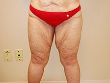 Thigh Lift before 601380
