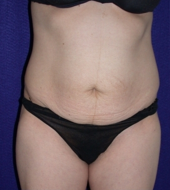 Tummy Tuck (abdominoplasty) before 208471