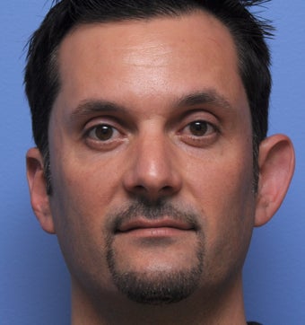 Otoplasty before 361344