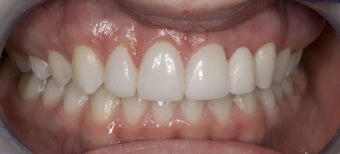 Porcelain Bridge and Veneers after 374741