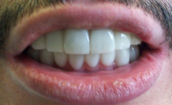 Snap-on Smile after 535255