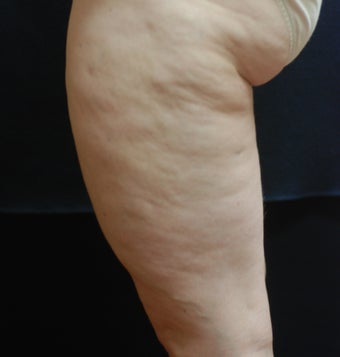 SmoothShapes Cellulite Treatment before 624764