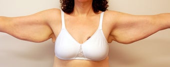 Brachioplasty before 524822