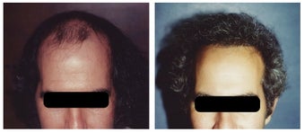 hair transplant before 369163