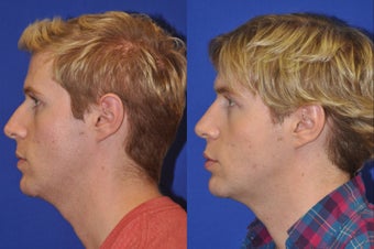 Endonasal Rhinoplasty before 278347