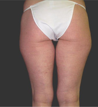 Exilis after 423768
