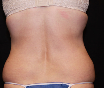 Laser Liposuction before 362280
