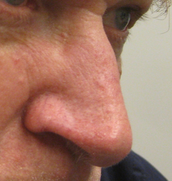 Skin cancer excision with skin graft repair after 313144