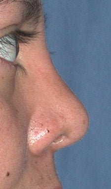 Rhinoplasty - Surgical Revision after 98855