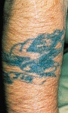 Laser tattoo removal before 374505
