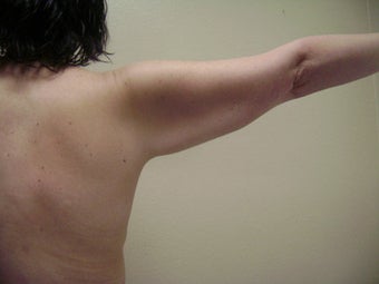 Arm Lift before 155761