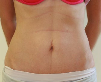 Mini-abdominoplasty after 493679