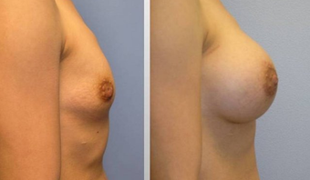 Breast Augmentation before 256396