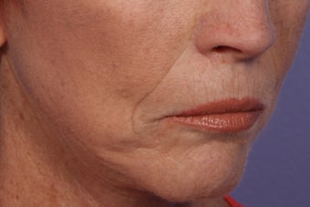 Radiesse and Juvederm - Smile lines 309227