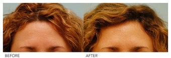 Botox before 138521