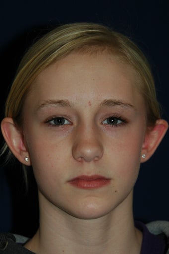 Otoplasty before 565618