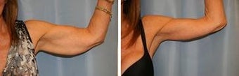 62 years old / brachioplasty, (arm lift) before 344017