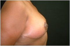 Breast Reduction after 205103