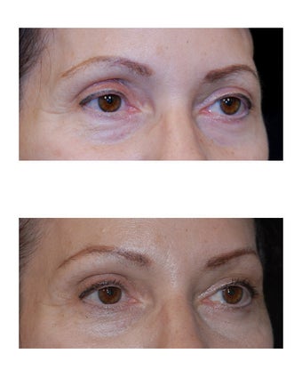 Lateral Brow Lift after 349203