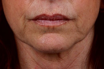 Thermage before 309255