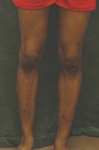 Men's Calf Augmentation 519061
