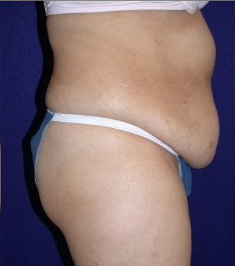 abdominoplasty 208462