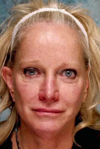 Revising cheek implants and fixing eyelids before 118559