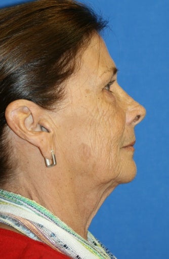 facelift before 264051