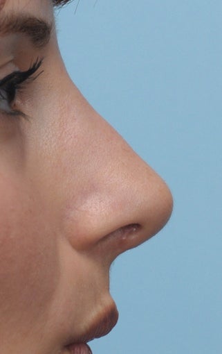 Rhinoplasty 361321