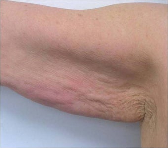 Accent for Cellulite Treatment after 600365