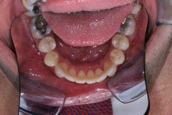 Invisalign 372721