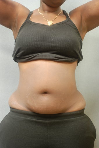 Upper and lower Abdomen & Flanks before 346579