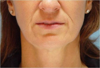 Restylane in Nasolabial folds and Marionette lines before 251710