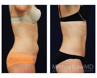 Liposuction 495040