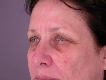 Eyelid Surgery before 306443