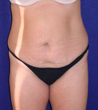 Tummy Tuck (abdominoplasty) before 208480