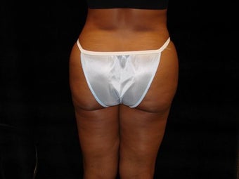 Buttocks Augmentation after 517579