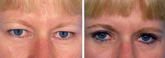 Blepharoplasty before 643210