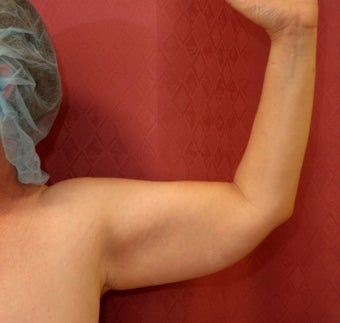 Brachioplasty or arm tuck before 583684