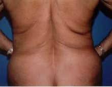 Body Contouring before 611086