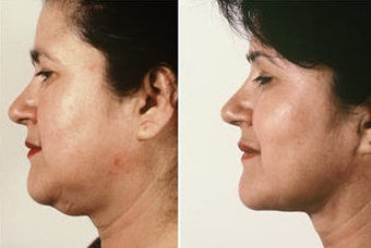 Necklift with Jowl Liposuction before 69080