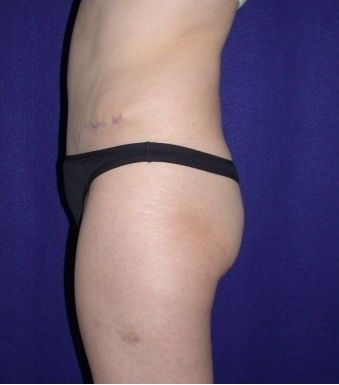 Tummy Tuck (abdominoplasty) 208468