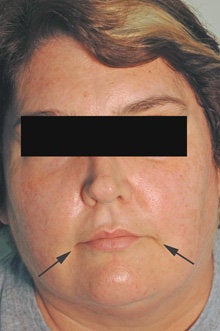 Botox and Restylane for Mouth Frown after 91054