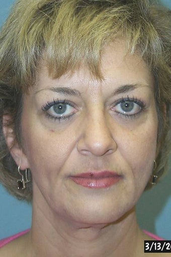Full Facial Rejuvenation before 148582