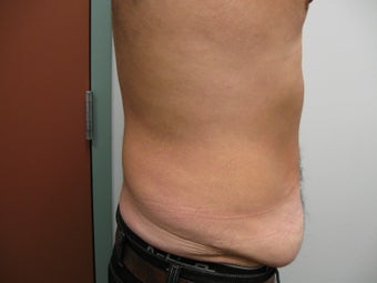 Abdominoplasty on 42 Year Old Male 340025