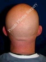 Ear Surgery (Otoplasty) 584566