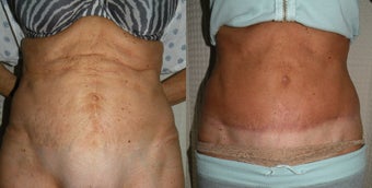 Tummy Tuck Revision before 400493