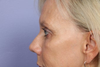 Eyelid Surgery after 306432