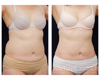 Liposuction after 495477