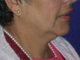 Necklift 208453